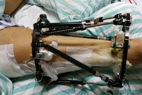 總結(jié)碳纖維聚醚醚酮復(fù)合材料的5點優(yōu)勢