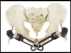 熱塑性PEEK碳纖維骨科固定架優(yōu)勢